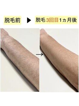 レーヴ/腕脱毛の効果☆