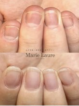 マリーロール 天王寺店(Marie Laure)/自爪育成/深爪矯正/ネイルケア