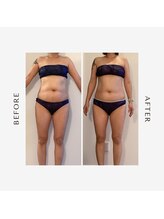 ラグレ(LUXRE)/脂肪冷却モニター（40代）