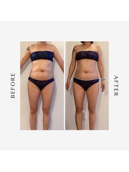 ラグレ(LUXRE)/脂肪冷却モニター（40代）