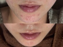 リボーン(REBORN)/繰り返すお肌悩みに