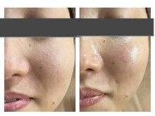 ザ ワン(THE ONE)/ヒト幹細胞導入