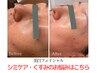 【美白フェイシャル】シミ集中ケア/美白成分導入　90分コース