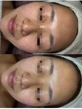 ココリール/赤み、乾燥肌