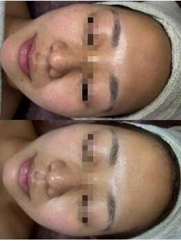 ココリール/赤み、乾燥肌