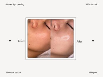 アンフェム(Anfem)/水光ピーリング×生美容液導入