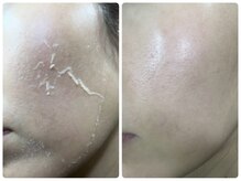 パールプラス 恵那店(Pearl plus)の雰囲気（剥離ありなしハーブピーリング☆お肌に合わせてご提案いたします）