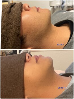 素肌新館 沼津店/メンズ脱毛