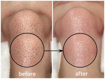 毛穴専科/ワックス脱毛メンズok/沖縄/那覇