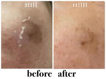 キュート 川越店(Cute)/ハーブピーリング【ハード】