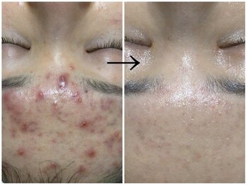 メンズサロンエヌエー(MEN'S SALON NA)/【肌質改善・ニキビケア】