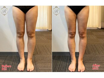 ルフレ(REFLET)/【事例9】Before/After/痩身