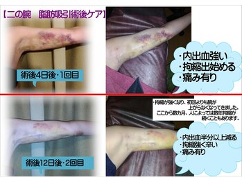 魔女のきもち/インディバで術後ケア