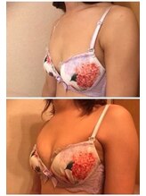 美人バスト 町田店/バストアップ◇症例◇