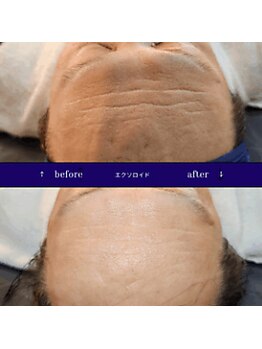 ティア(TIA)/スーパージェクション