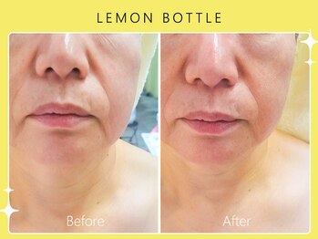 ハノハノ 八代店(HANO HANO)/【八代初導入！】レモンボトル☆