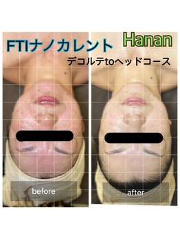 ハナン(Hanan)/FTIナノカレント脳ダイエット
