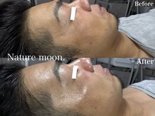 ナチュールムーン(Nature moon.)/ハーブピーリング