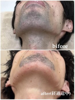 モット いこらもーる泉佐野店(mot)/メンズ★ヒゲ脱毛