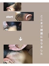 リアンジェ(Lianje)/うなじ美肌脱毛　途中経過