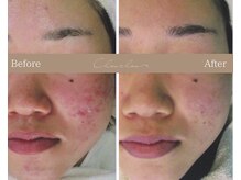 シュシュ(Chou chou)/【Before★After】ニキビ改善