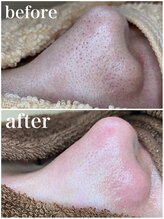 毛穴専科/ワックス脱毛メンズok/沖縄/那覇