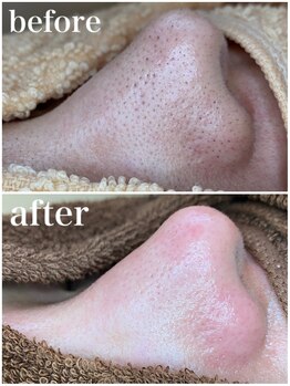 毛穴専科/ワックス脱毛メンズok/沖縄/那覇