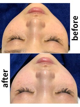 ハーニーズ(HARNEYS)/【フェイシャル】before after