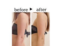 サロン ド ユキフラン(Salon de Yukifranc)/施術部位→二の腕・肩甲骨