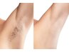 【男女】★脱毛体験★ カウンセリング付き 両ワキ脱毛 剛毛/産毛に効果抜群◎