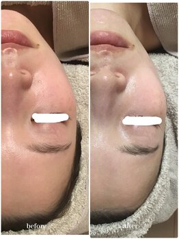 アミィ(amii)/肌育ボンバーフェイシャル