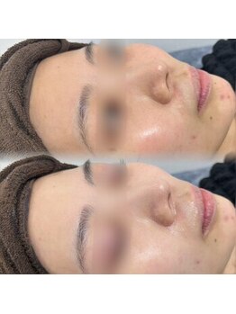 プラシア 広島駅(Purasia.)/水光肌管理コース