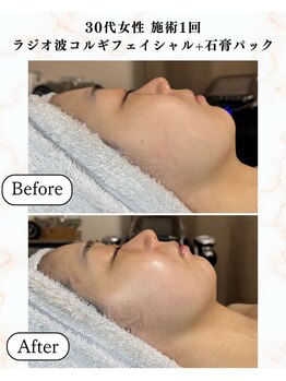 シーフェイス 横浜店(SEE FACE)/ラジオ波小顔コルギフェイシャル