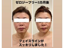 水素イオンジェルとゼロジーフリーでお肌のキメUP・シミケア◎