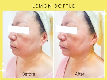 ハノハノ 八代店(HANO HANO)/【八代初導入！】レモンボトル☆