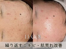 ルコル(LUCOL)の雰囲気（WiQo水光ピーリングで繰り返すニキビ・肌荒れに終止符を！）