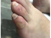 ナチュラル フット ネイル(Natural Foot Nail)/小趾のタコ