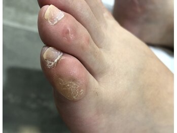 ナチュラル フット ネイル(Natural Foot Nail)/小趾のタコ