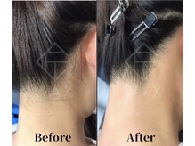 トゥルーカインド(true kind)/うなじWAX脱毛