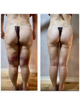 スリーピングビューティー(Sleeping Beauty)/インディバ　術後ケア！