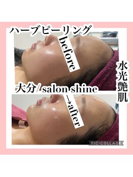 サロンシャイン(Salon Shine)/ハーブピーリング１回水光艶肌