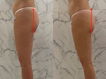 エーアイビューティー 御徒町店(Ai Beauty)/ 【ヒップアップ例】