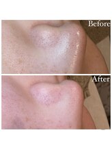 マドモアゼル 麻布十番/毛穴洗浄