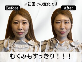 ハリユナイテッド 原宿鍼灸 整体院(HALI UNITED)/毎朝のむくみをスッキリ!!