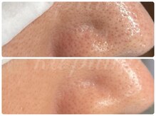 カピリナ(ka pilina)/★上下施術前のお写真★