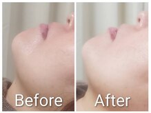 ミヨン ヨコハマ(Miyonne Yokohama)/LDM Aqua＋小顔ヘッドスパ上大岡