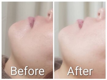 ミヨン ヨコハマ(Miyonne Yokohama)/LDM Aqua+小顔ヘッドスパ上大岡