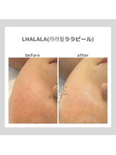 韓国肌管理室pom.haneul【ポムハヌル】LDM/インモード/ララピール/プラピール福岡天神/韓国肌管理室