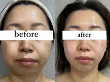 ウィズルーチェ 麻布十番店(with luce)/小顔へ♪年齢によるたるみケア