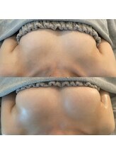 美人バスト 渋谷店/【バストアップ】症例☆